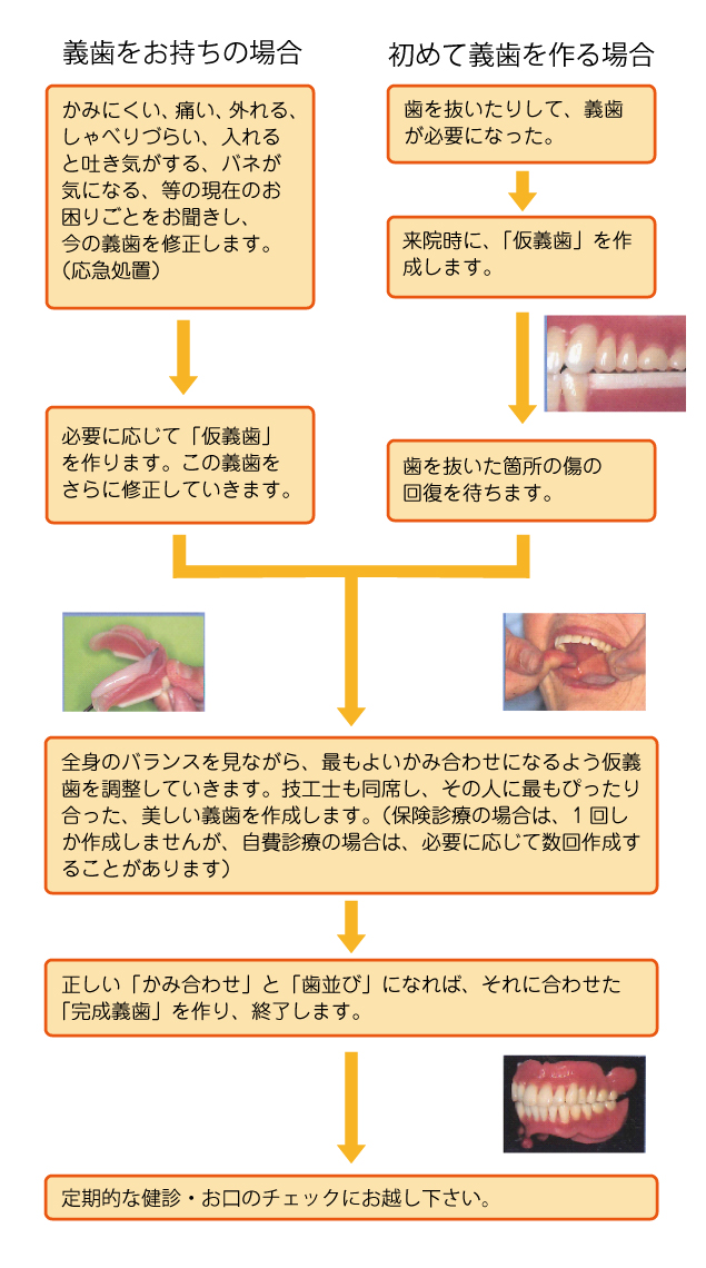 精密義歯の製作方法